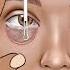 Asmr Eye Stone Removal Eyelid Sebum Extrusion Meibomian Gland Cleaning Animation Beauty