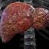 Understanding Liver Cirrhosis The Silent Damage