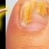 1 BEST Toenail Fungus Treatment Top 10 Home Remedies 2024