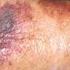 ACTINIC SENILE PURPURA Causes Treatment What Is Senile Solar Purpura