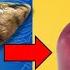 Strictly Avoid These 5 Foods If You Have Fatty Liver Fatty Liver Treatment Liver Disease