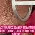 FractionalCO2laser Treatment For Acne Scars Dermatologist Skin Tightening Chandigarh Shorts