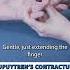 Is Dupuytren S Contracture Causing Your Discomfort