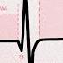 The Cardiac Cycle On An EKG P QRS T Waves