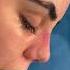 Extreme Thick Skin Rhinoplasty Dr TAS