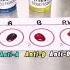 Blood Typing Or Blood Grouping Step By Step Laboratory Medtech Medtechstudent Mls Mt Bloodbank