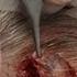 Ninis Mystery Scalp Lesion Excision Part 1