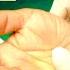 CARPAL TUNNEL RELEASE LIVE SURGICAL PROCEDURE CARPAL TUNNEL SYNDROME EVERYTHING YOU NEED TO KNOW