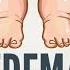 Edema Causes Signs And Symptoms Diagnosis And Treatment