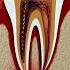 Root Canal Treatment Tooth Abscess