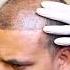 PRP Treatment For Hairloss Hair Transplant Clinic Dadu Medical Centre