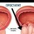 Простатити шадид Бемории мардон Сузок ва дард дар вакти пешоб кардан