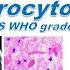 Pilocytic Astrocytoma CNS WHO Grade 1