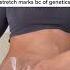 Clinically Proven Stretch Mark Treatment