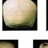 Skull Suture Pattern Individualization Based On Suture Patterns ANT