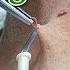 How To Remove Skin Tags Around Neck With Electric Cautery Skin Tag Removal Procedure