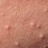 Acne Treatment Huong Da Nang 718 Remove Hidden Acne