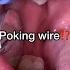 What To Do If You Have A Poking Wire Braces Emergency Tooth Time Family Dentistry New Braunfels