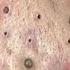 Big Cystic Acne Blackheads Extraction Blackheads Milia Whiteheads Removal Pimple Popping 1