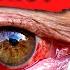 Bloodshot Eyes What Causes Bloodshot Eyes And How To Get Rid Of Them Doctor Eye Health