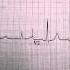 Cardiac EKG Tracings ECG Reading Dr Ben Zur