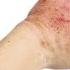 Is Your Eczema Coming From A Salicylate Sensitivity Dr Berg On Atopic Dermatitis