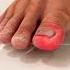 What Is An Ingrown Toenail