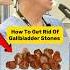 How To Get Rid Of Gallbladder Stones Shorts