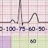 ECG Basics Methods Of Heart Rate Calculation