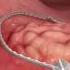 Endoscopic Mycosal Resection EMR Procedure Overview Of A Sessile Polyp Using Olympus Devices